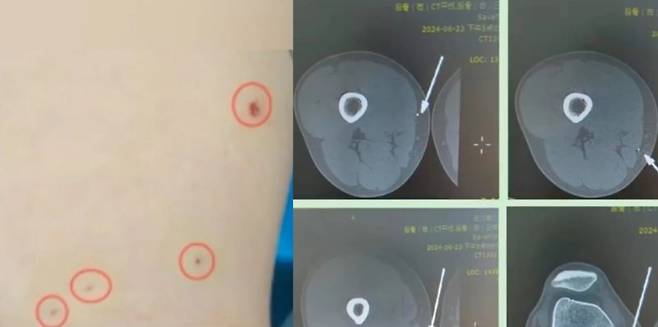 중국의 한 남성이 마블 영화의 대표적인 캐릭터 '아이언맨'을 따라하려다 병원으로 이송돼 응급 처치를 받았다는 사연이 전해졌다. /사진=weibo, 뉴시스