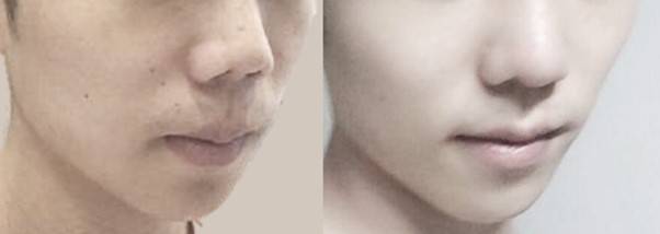 코가 짧아 인중이 길어 보이면, 원인은 코에 있습니다.