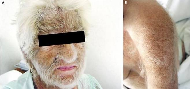 성인이 된 후 원인 모를 긴 솜털이 자꾸 자란다면 암의 징후일 수 있다./사진=틱톡 채널 'denverskindoc' 캡처