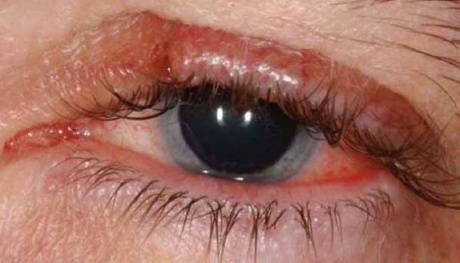 다래끼가 반복적으로 생기고 잘 낫지 않는다면 드물지만, 피지샘암을 의심해야 한다./사진=OPHTHALMOLOGY BREAKING NEWS 캡처