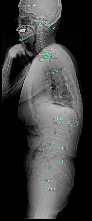 측면 전척추 X-ray 영상에서 딥러닝 시스템이 찍은 랜드마크(기준점) 모습. (아주대병원)