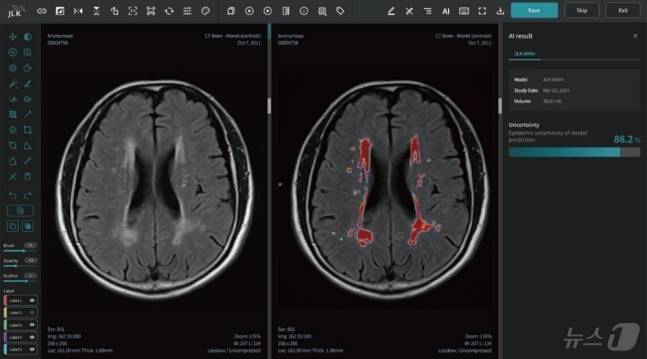 대뇌백질변성분석 AI 솔루션 JLK-WMH. 제이엘케이.