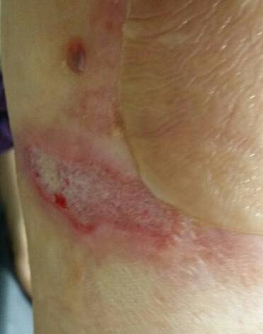 학교급식 조리 과정 중 끓는 물에 화상을 입은 조리실무사의 신체 부위. 2014년엔 다리에 힘이 풀린 조리실무사가 뜨거운 물이 담긴 대야에 주저앉아 사망한 사고도 있었다. 민주노총 교육공무직본부 공공운수노조 전국교육공무직본부 제공.