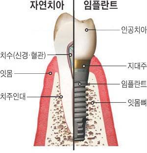 자연치아(왼쪽)와 임플란트의 단면 비교 모습.