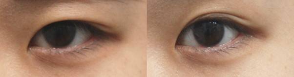 내시경 이마 눈썹 거상으로 눈썹을 들어 눈동자의 앞쪽이 잘 보이도록 올려줌.