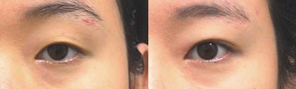 쌍꺼풀 수술로 눈 앞머리를 가리는 피부를 접어주면 앞쪽 느낌이 좋아짐.