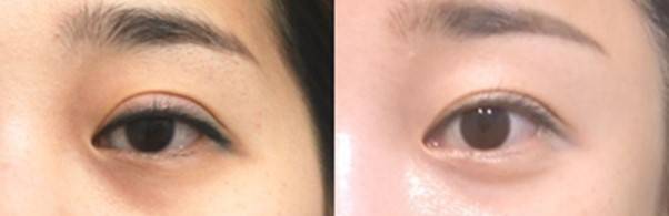 쌍꺼풀 라인을 낮춰 눈동자의 노출을 개선할 수 있음.