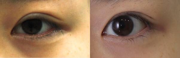 눈매교정술로 눈꺼풀 뜨는 힘을 강화해 눈 앞머리 쪽이 또렷하게 보이도록 만들어줌.