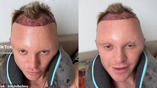 영국의 한 틱톡커가 최근 모발 이식으로 인한 증상을 공유했다./사진=데일리메일