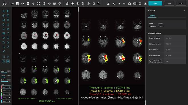 제이엘케이의 뇌혈관류 분석 인공지능(AI) 솔루션 'JLK-PWI'./제이엘케이