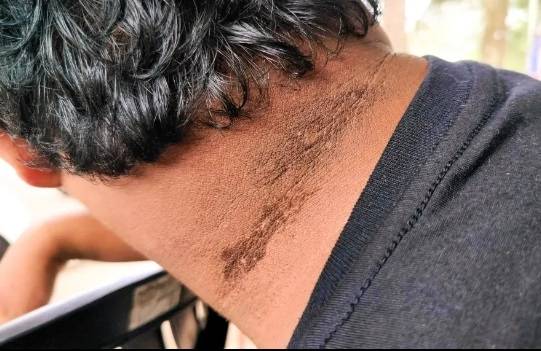 목 주위의 검은 반점.[뉴욕포스트 캡처]