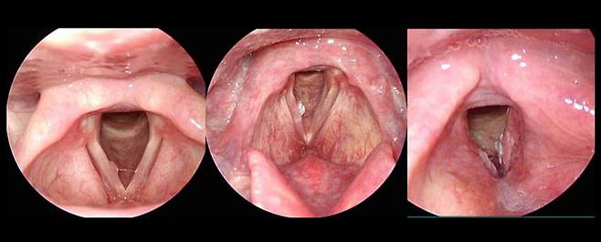 후두에 생긴 물혹(맨 왼쪽), 바이러스로 인한 사마귀 조직(가운데)과 달리, 단단하고 꽉 채워진 혹(맨 오른쪽)이 후두암이다. /사진=서울시보라매병원