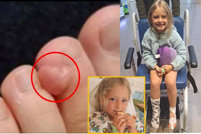 두 번째 발가락에 혹처럼 튀어나온 것을 보고 의사는 사마귀로 진단했지만 결국 종양인 것으로 밝혀진 한 어린 소녀의 사연이 공유됐다. [사진=영국 일간 더선 보도 갈무리]