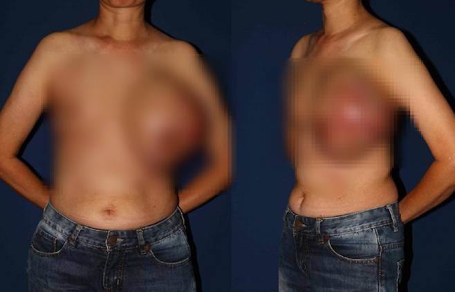 가슴에 엽상종이 발생하면서 한쪽 유방이 과도하게 커진 모습./사진=국제외과저널사례보고
