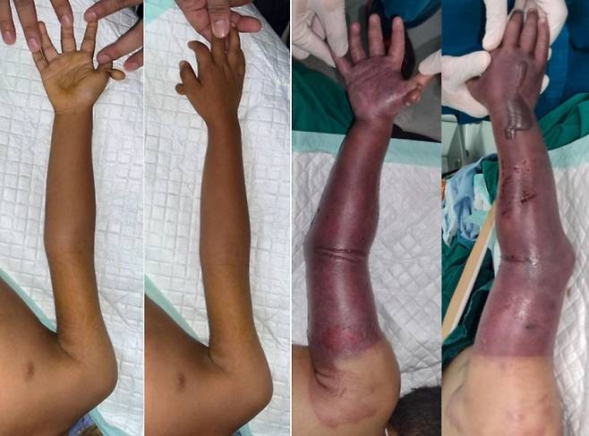 인도네시아 4세 남아는 팔이 부러져 병원을 찼았을 당시(왼쪽 사진)에는 큰 문제가 없었지만, 수술을 거부하고 접골원 치료를 받은 후 하루 만에 팔이 검게 변한 상태로 다시 응급실을 찾았고(오른쪽 사진) 결국 팔을 절단해야 했다./사진=국제외과저널사례보고