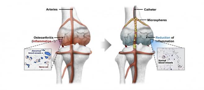 카테터(Catheter) 쓰여진 부분에 넥스피어 에프가 주사되고 있다. 이는 넥프피어에프가 관절염 통증을 완화하는 원리를 그린 그림이다. / 사진= 넥스트바이오메디컬 홈페이지 갈무리