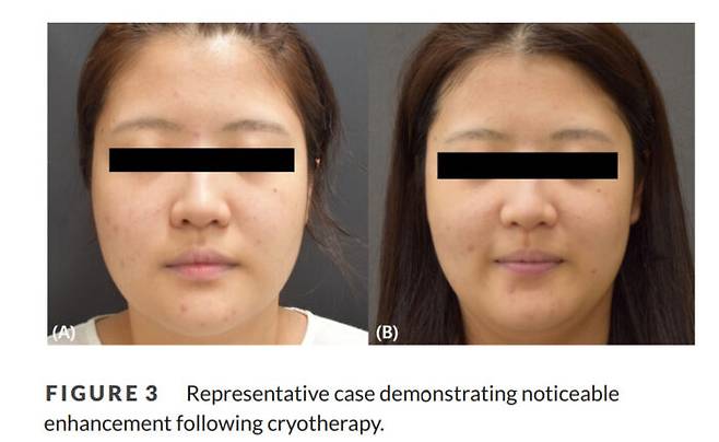 정밀냉동요법 치료 전후 비교 사진(왼쪽 치료 전, 오른쪽 치료 후) [사진=중앙대병원]