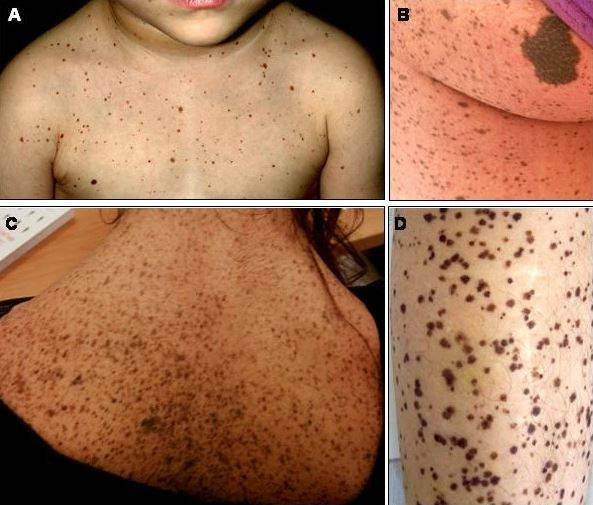 레오파드 증후군은 환자마다 나타나는 증상이 다르지만, 90% 이상에게 피부 이상이 나타난다./사진=Orphanet Journal of Rare Diseases