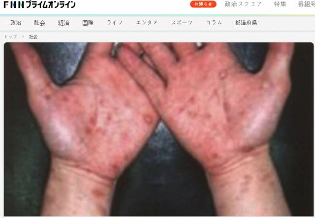 매독 증상. 후지 뉴스 네트워크 보도 캡처