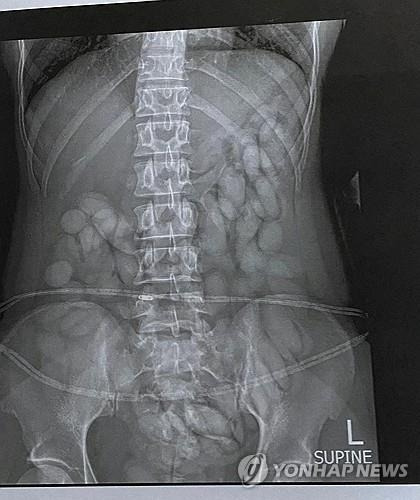 마약을 배속에 숨긴 채 입국하려 한 마약 운반책의 엑스레이 촬영 결과. [사진 출처 = 연합뉴스]
