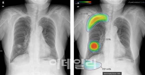 루닛 AI 흉부 엑스레이 병변 탐색 모습 (사진=루닛)