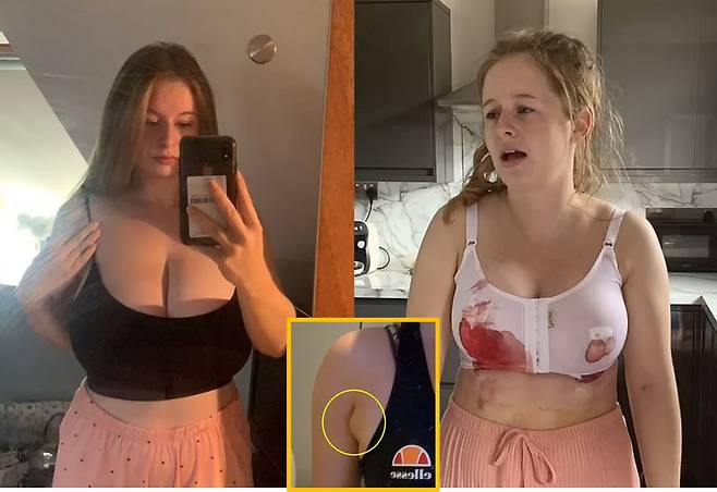 무려 K컵의 거대한 가슴을 지닌 한 여성이 가슴 축소술을 받은 후 부작용에 시달린 경험이 공유됐다. 하단 사진= 수술 후 생긴 혹이 튀어나와 있다. [사진=영국 일간 데일리메일 보도 갈무리]