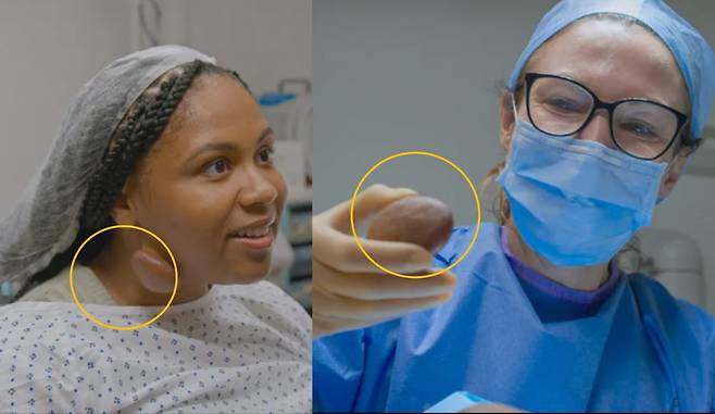 올리비아의 경우 켈로이드가 주변 피부 깊숙이 뿌리내리지 않았다며 외과적으로 절개하는 방법으로 수술을 진행했다. [사진=영국 일간 더선 보도 갈무리]