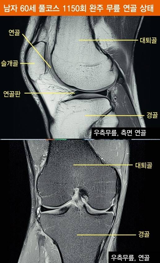 마라톤을 1150회 이상 완주한 60살된 남자의 무릎 연골 상태. 서승우 고려대구로병원 정형외과 교수 제공.