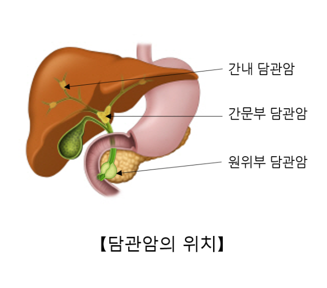 담도암은 암이 생기는 위치에 따라 간내 담관암, 간문부 담관암, 원위부 담관암으로 나뉜다. 사진 제공=서울아산병원