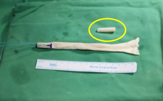 인대 재건술에 쓰는 아킬레스건의 모습. 노란색 동그라미가 터널의 빈틈을 메우우는 '본블럭'이다. /사진=바른세상병원