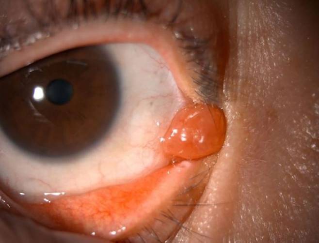 38세 여성의 눈물언덕에 생긴 말트 림프종의 모습/사진=대한안과학회지