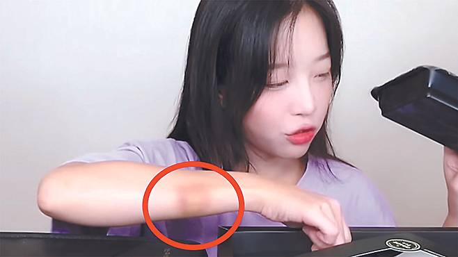 YouTuber Tzuyang displays a bruise on her right arm. [SCREEN CAPTURE]