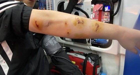 A man who was bitten by the wild pig boar shows his injured arm. [GYEONGSANGNAM-DO FIRE DEPARTMENT]