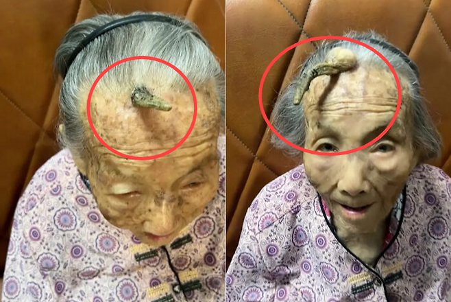 이마에 10cm 뿔을 지닌 107세 중국 할머니가 화제다. [사진출처 = 뉴욕포스트]