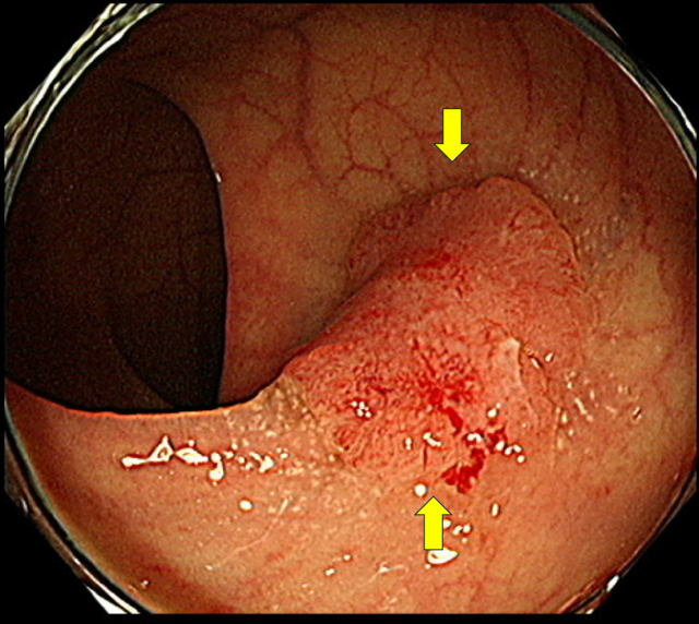 대장내시경 검사 결과 조기 대장암(노란색 화살표) 소견이 관찰된다. 사진 제공=서울아산병원