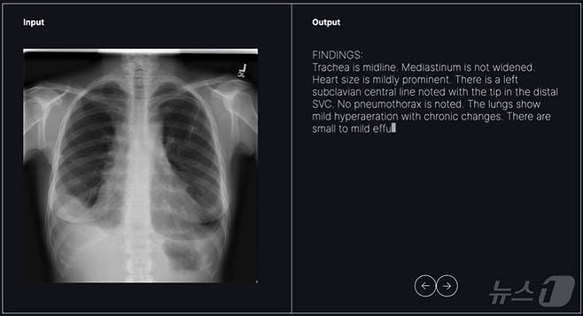 숨빗AI가 개발 중인 영상의학과용 초기 판독문 생성 솔루션 'AI리드-CXR' 활용 모습.(숨빗AI 제공)/뉴스1 ⓒ News1
