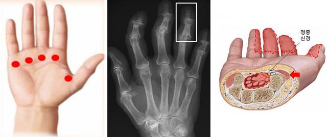 방아쇠수지 발생 부위(왼쪽)와 손가락관절염 X선 영상(가운데), 손목터널증후군을 유발하는 손목터널 내 정중 신경.