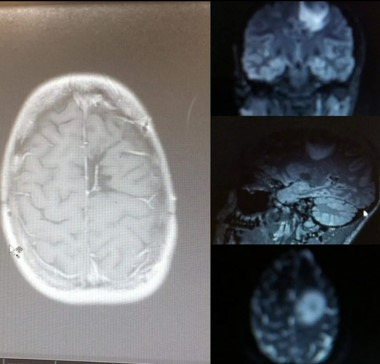 에이미는 MRI 검사를 통해 자신의 뇌에 골프공 크기의 종양이 있다는 충격적인 진단을 받았다. 검사 결과, 뇌종양(brain tumor)이었다. [사진=영국 일간 더선 등 보도 갈무리]