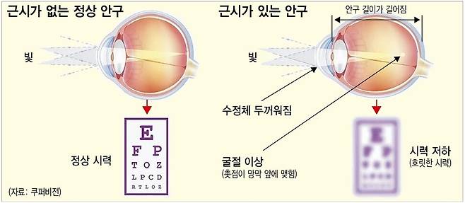 근시와 눈의 변화. 자료 : 쿠퍼비전