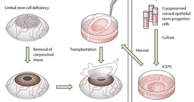 혈액세포를 배아줄기세포 상태로 만든 유도만능줄기세포(iPS세포)를 분화시켜 각막 조직으로 만든 뒤 기존 각막 조직을 제거한 환자의 눈에 이식한 과정. 환자 4명 중 3명에서 시력 회복 효과가 나타났다./일 오사카대 의대
