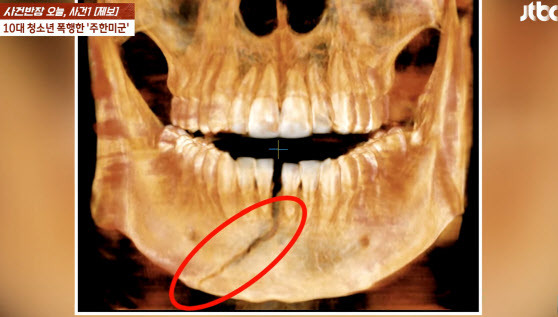 주한미군에 맞아 턱뼈가 골절된 10대 남학생의 엑스레이 사진 (사진=JTBC 사건반장 방송 캡처)