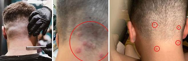 빨간색으로 표시된 두부 백선 증상./사진=데일리메일 제공