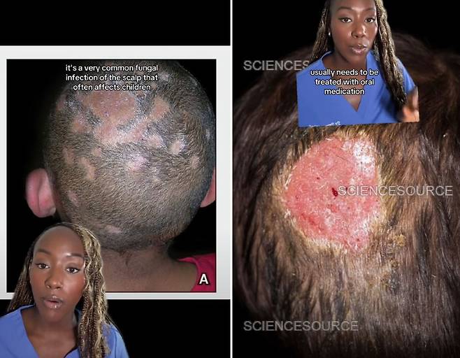 영국의 피부과 의사가 스킨 페이드 컷을 하면 탈모가 유발할 수 있다고 밝혔다./사진=틱톡 채널 ‘dermdremma’ 캡처