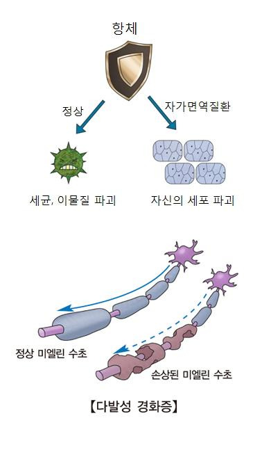 자가면역질환(예: 다발성 경화증). 서울아산병원