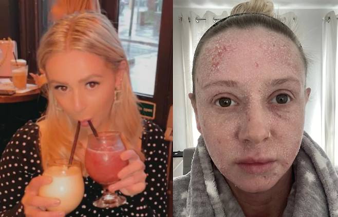 30년동안 사용해온 스테로이드 크림을 끊으면서 상상을 초월한 심각한 부작용에 시달리는 30대 여성의 사연이 전해졌다. [사진=영국 일간 더선 보도 갈무리]