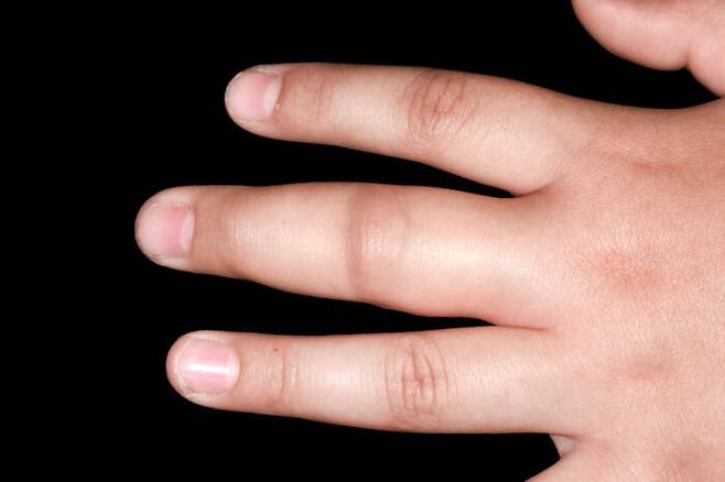 손가락이 붓고, 통증이 동반되면 여러 질환이 원인일 수도 있다. [사진=클립아트코리아]