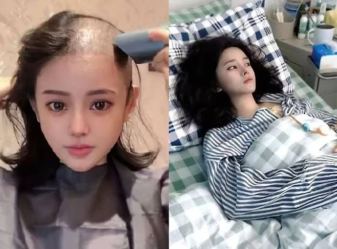 대장암 판정 후 9번의 항암 치료를 받았으나 치료를 포기한 중국 틱톡커 카페이가 머리를 미는 모습(왼)과 누워있는 모습(오)/사진=구디 25
