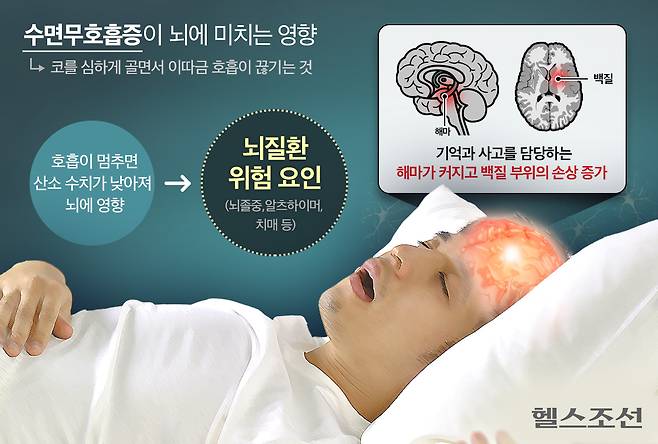 수면무호흡증이 있는 사람은 기억과 사고를 담당하는 뇌 부위인 해마가 커지고 백질 부위의 손상이 증가할 수 있는 연구 결과가 나왔다./그래픽=최우연