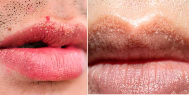 혹시 입술 주위에 생긴 작은 혹이나 반점들이 보인다면? 콜레스테롤이 정상범위를 초과한 상태일 수도 있다. [사진=건강의학매체 헬스라인, 영국 일간 미러 캡처]