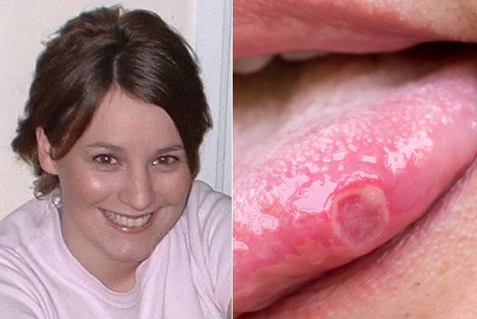 입안에 궤양이 생긴 후 4년 만에 구강암 판정을 받고 사망한 23세 영국 여성 사연이 공개됐다. 오른쪽 사진은 참고를 위한 것으로 기사와 직접적인 관계 없음. [사진=영국 매체 더선 보도 갈무리(왼쪽) / 혀 궤양 =게티이미지뱅크 ]